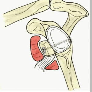 Latarjet Surgery